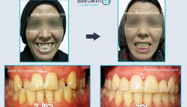 عکس قبل و بعد ارتودنسی