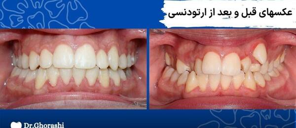 عکس قبل و بعد ارتودنسی