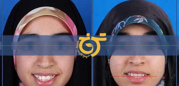 عکس قبل و بعد ارتودنسی