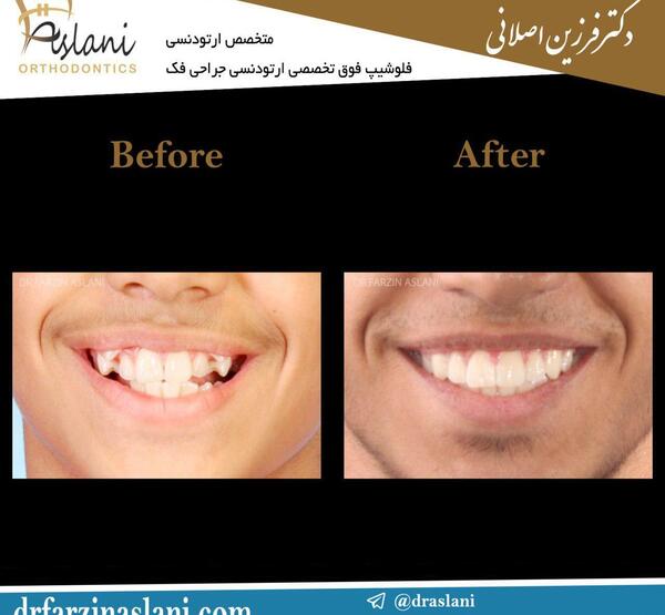 عکس قبل و بعد ارتودنسی