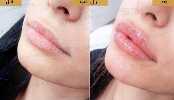 عکس لب تزریق ژل