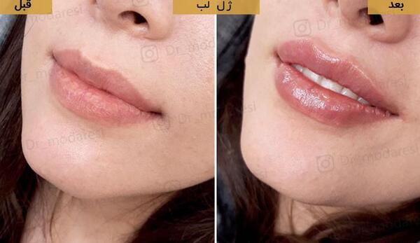 عکس لب تزریق ژل