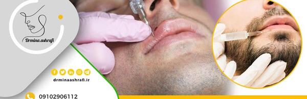 عکس لب تزریق ژل