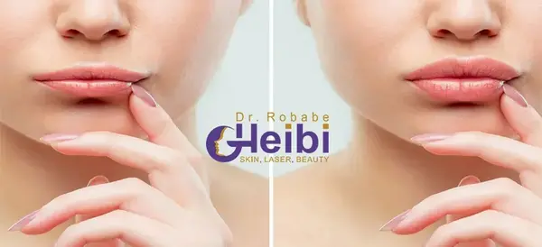 عکس لب تزریق ژل
