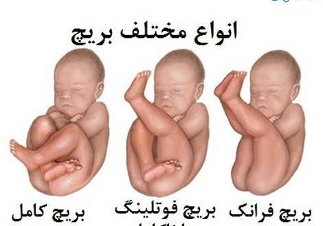 عکس جنین در حالت نشسته