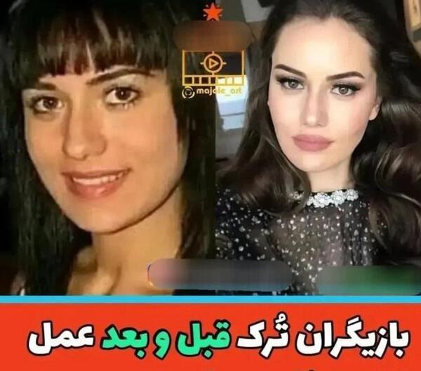 عکس های لیسا قبل از عمل
