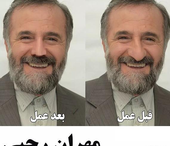 عکس های لیسا قبل از عمل