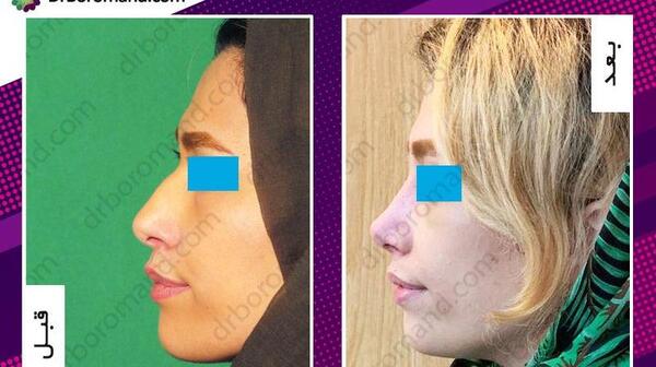 عکس روز اول جراحی بینی