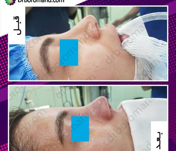 عکس روز اول جراحی بینی