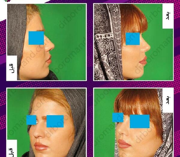 عکس روز اول جراحی بینی