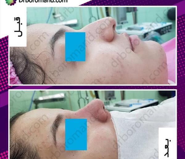عکس روز اول جراحی بینی