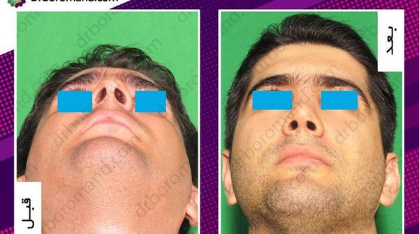 عکس روز اول جراحی بینی