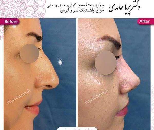 عکس روز اول جراحی بینی