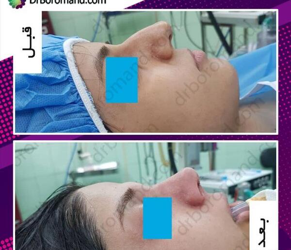 عکس روز اول جراحی بینی