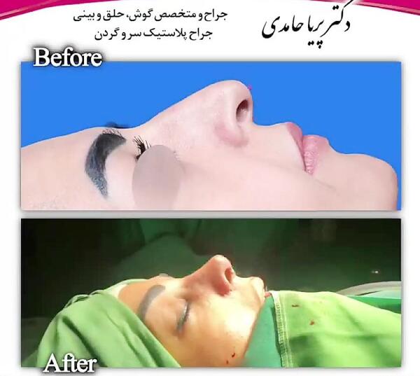 عکس روز اول جراحی بینی