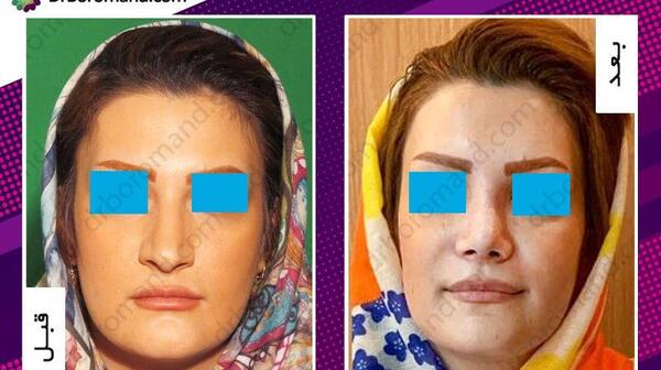 عکس روز اول جراحی بینی