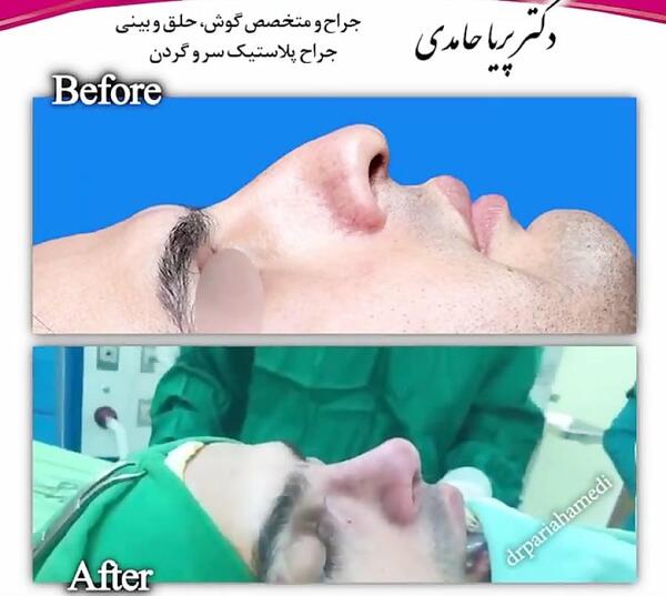 عکس روز اول جراحی بینی
