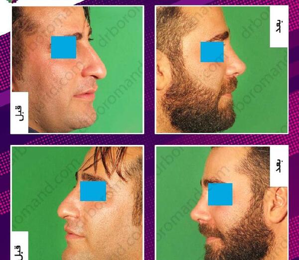 عکس روز اول جراحی بینی