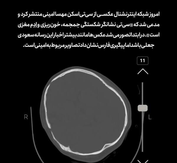 عکس سی تی اسکن مهسا امینی