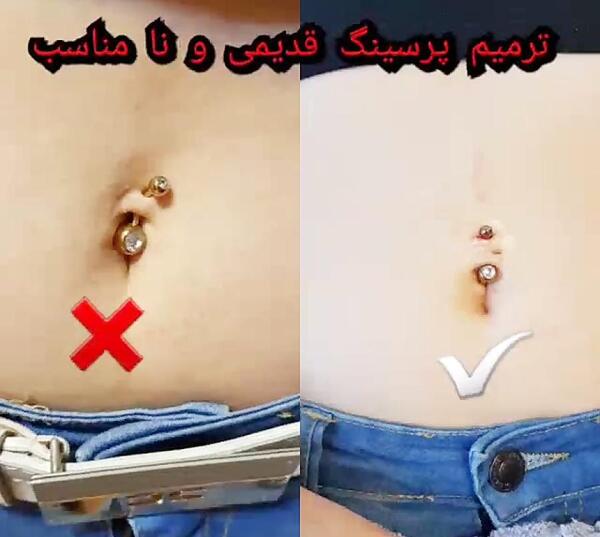 عکس عفونت پیرسینگ ناف