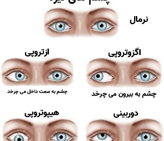 عکس دختر چشم چپ