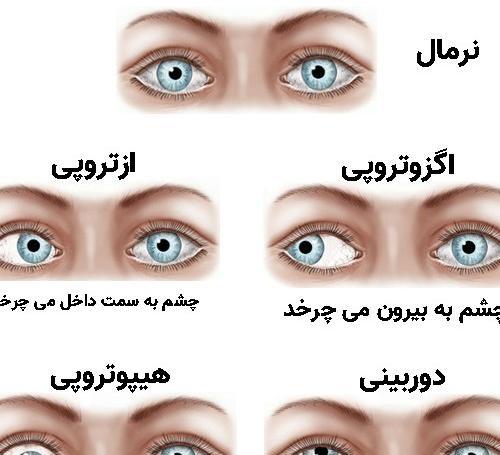 عکس دختر چشم چپ