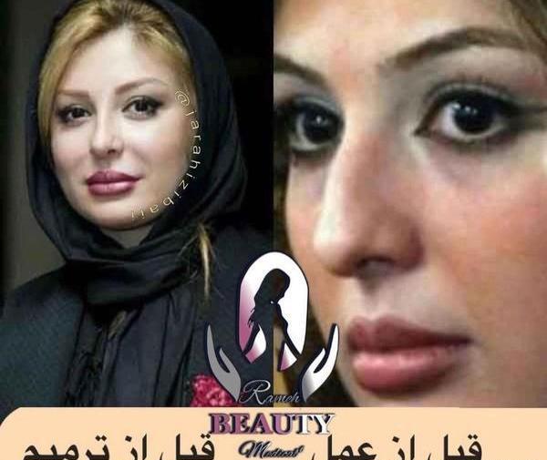 عکس قبل از عمل نیوشا ضیغمی