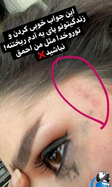 عکس کبودی چشم دختر