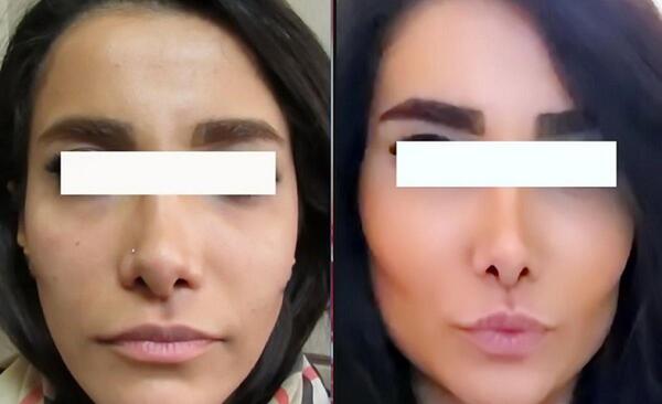 عکس قبل جراحی نانسی