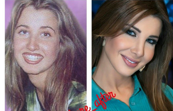 عکس قبل جراحی نانسی