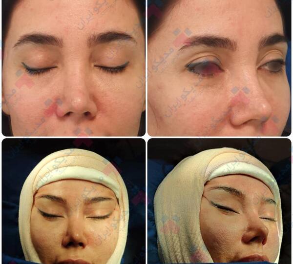 عکس قبل جراحی نانسی