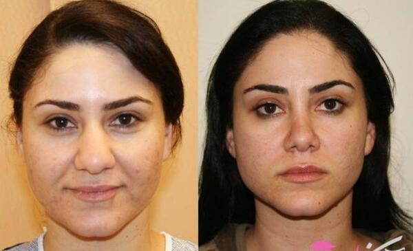 عکس قبل جراحی نانسی