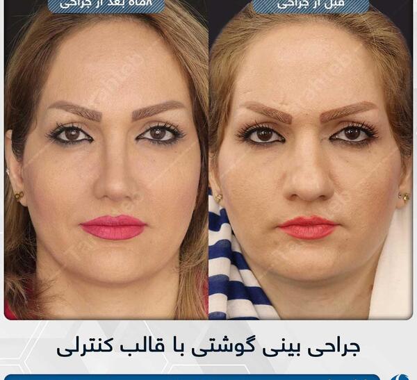عکس قبل جراحی نانسی
