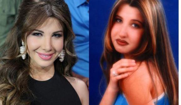 عکس قبل جراحی نانسی