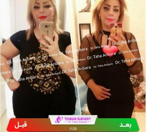 عکس قبل جراحی نانسی