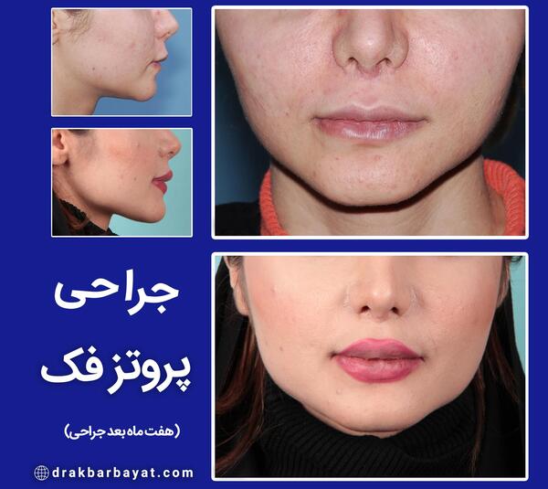 عکس قبل جراحی نانسی