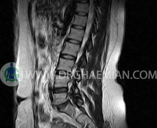 عکس ام ار ای از ستون فقرات