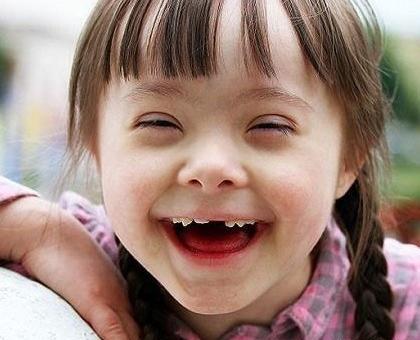 عکس کودک سندروم داون