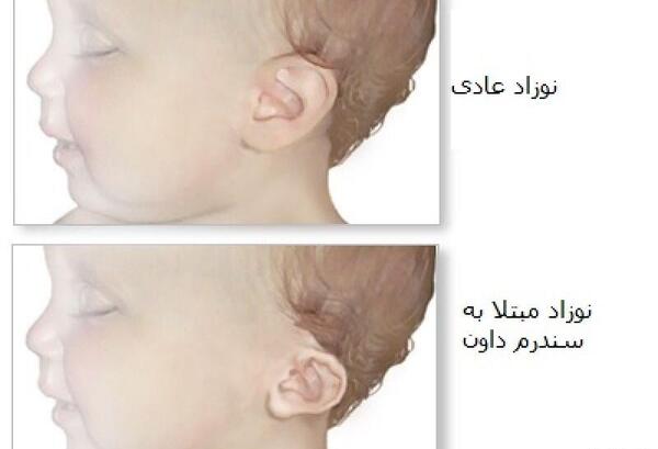 عکس کودک سندروم داون