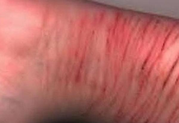عکس لواشک خودآزاری