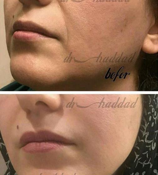 عکس قبل بعد بوتاکس