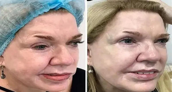 عکس قبل بعد بوتاکس