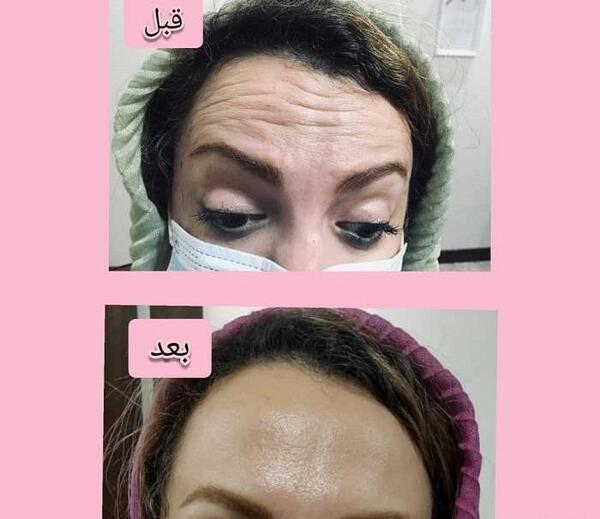 عکس قبل بعد بوتاکس