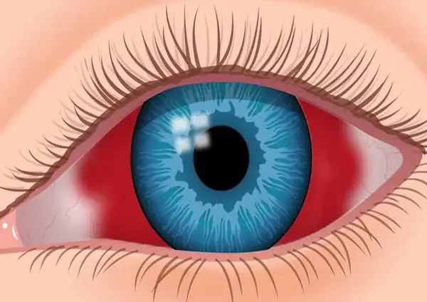 عکس چشم ضربه خورده