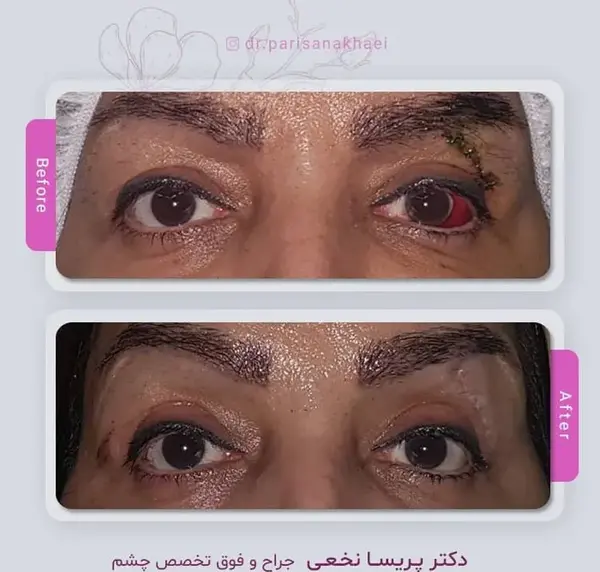 عکس چشم ضربه خورده