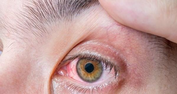 عکس چشم قرمز شده از گریه برای پروفایل