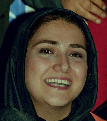 عکس باران کوثری قبل از عمل بینی