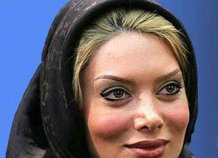 عکس باران کوثری قبل از عمل بینی