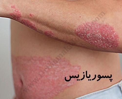 عکس روز جهانی پسوزیاریس