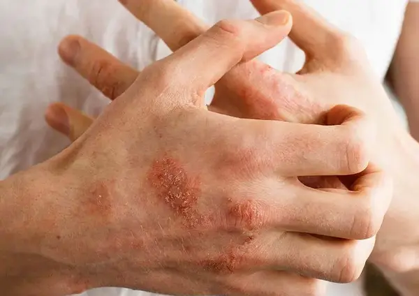 عکس روز جهانی پسوزیاریس